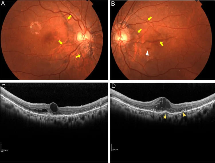 Angioid Streaks image