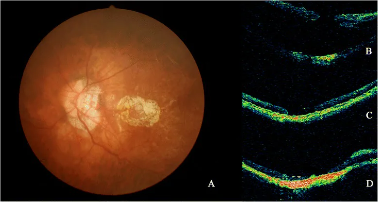 Atrophic Holes image