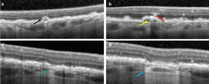 Avacincaptad Pegol image