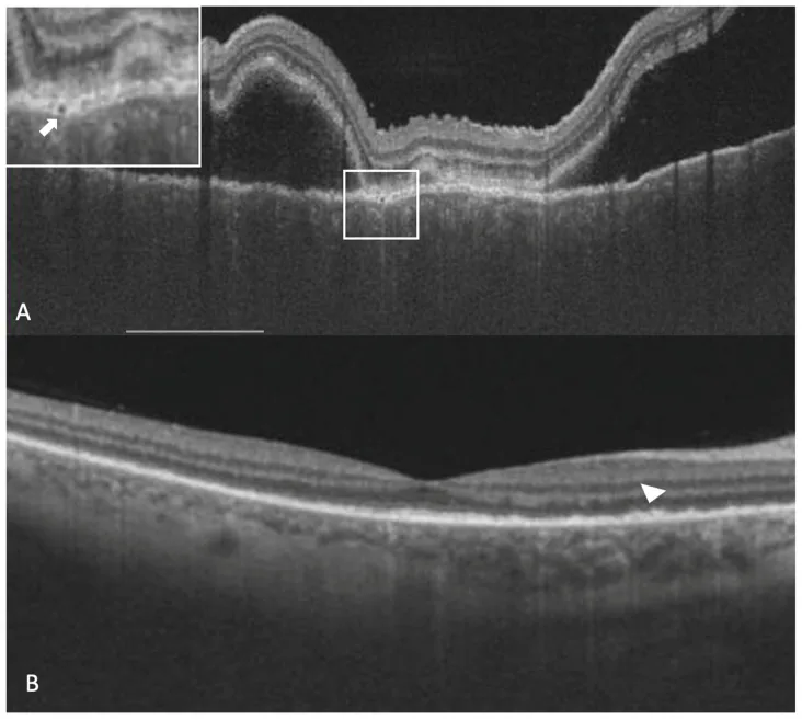 Bacillary Layer Detachment image
