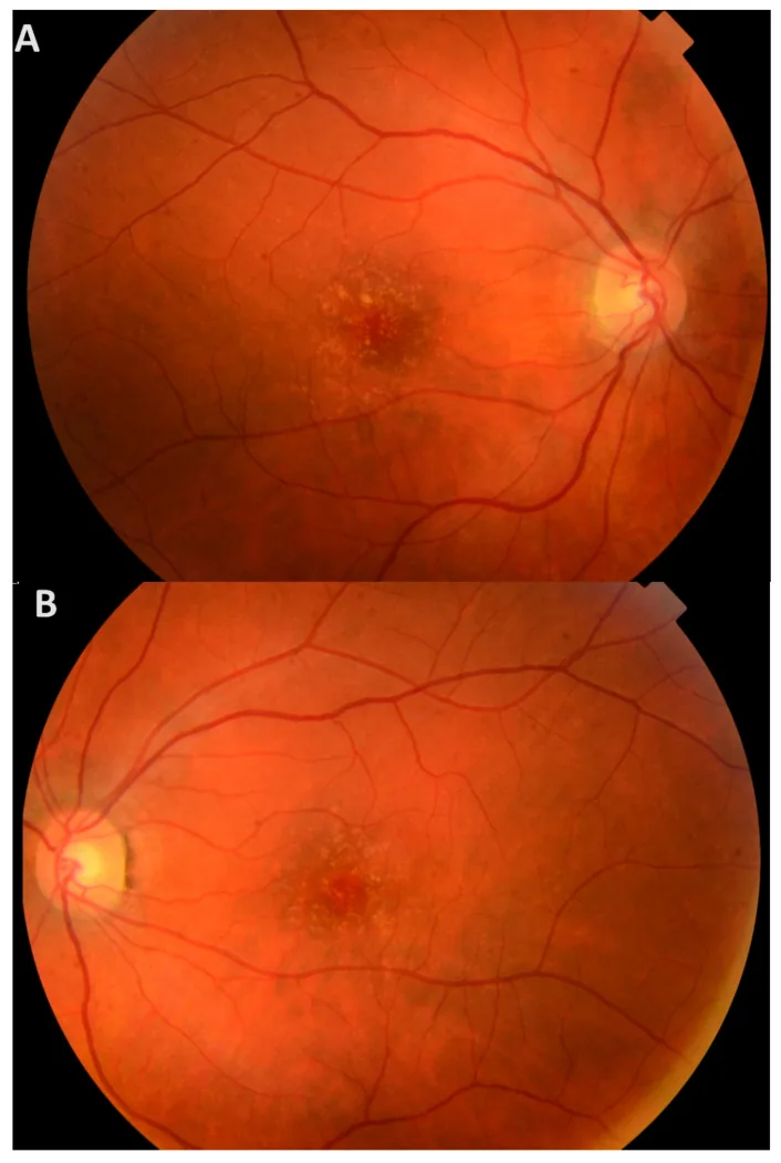 Basal Laminar Drusen image