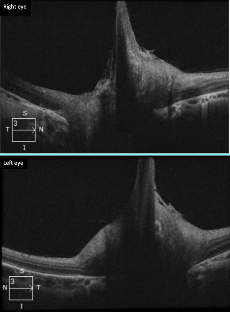 Bergmeister Papilla image