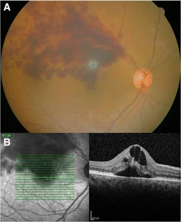 Bevacizumab image