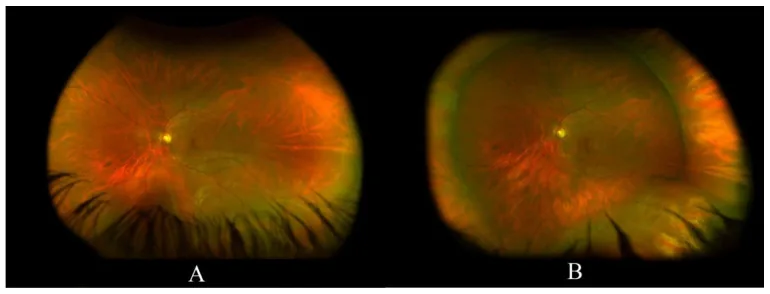 Binocular Indirect Ophthalmoscopy image