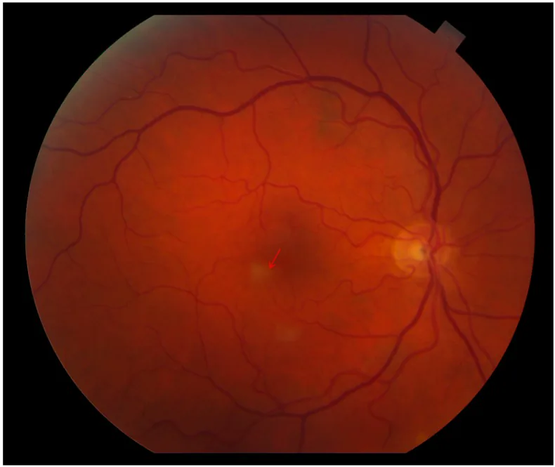 Branch Retinal Artery Occlusion image