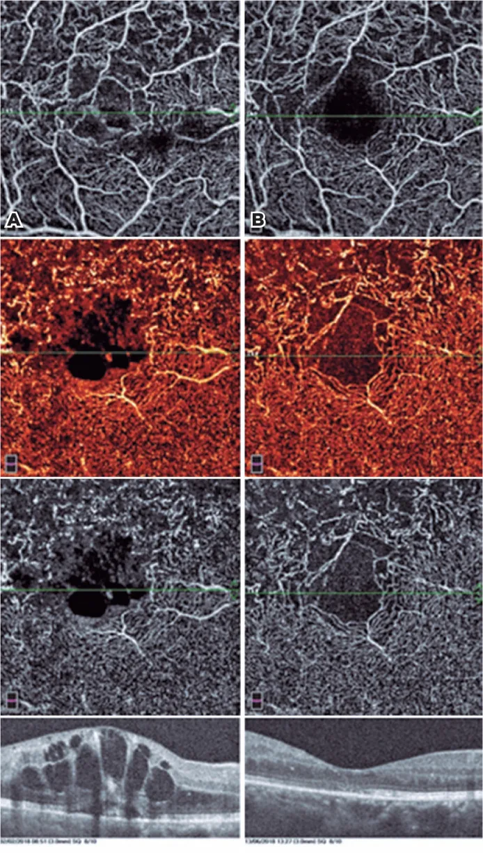 Branch Retinal Vein Occlusion image