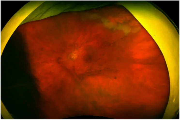 CMV Retinitis image
