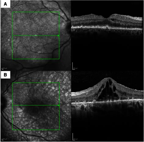 Cancer Associated Retinopathy image