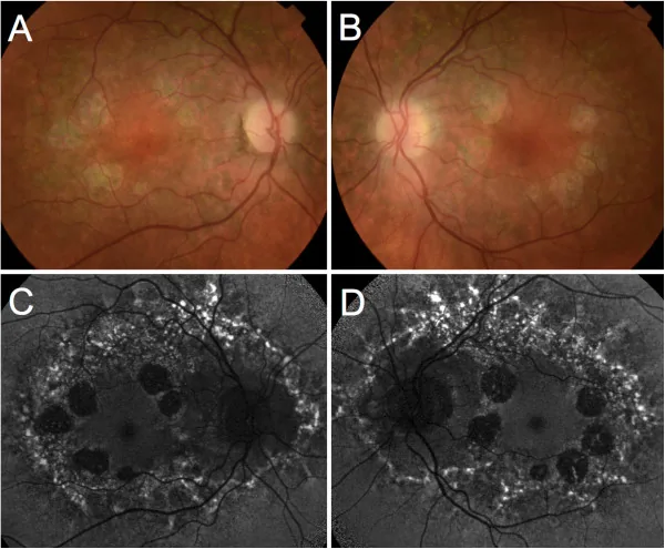 Central Areolar Choroidal Dystrophy image