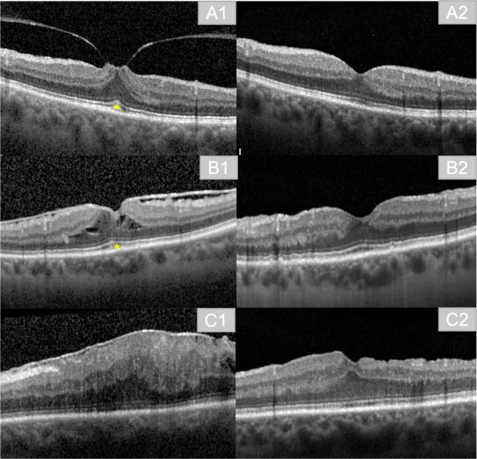 Central Foveal Bouquet Abnormalities image