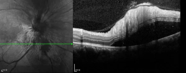 Central Retinal Vein Occlusion image