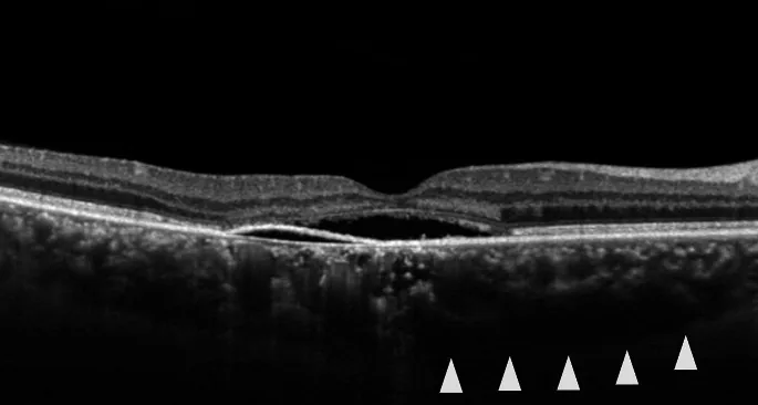Central Serous Chorioretinopathy image