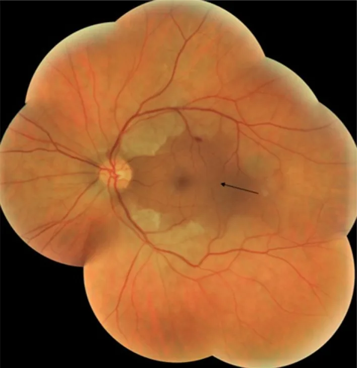 Cherry-Red Spot image