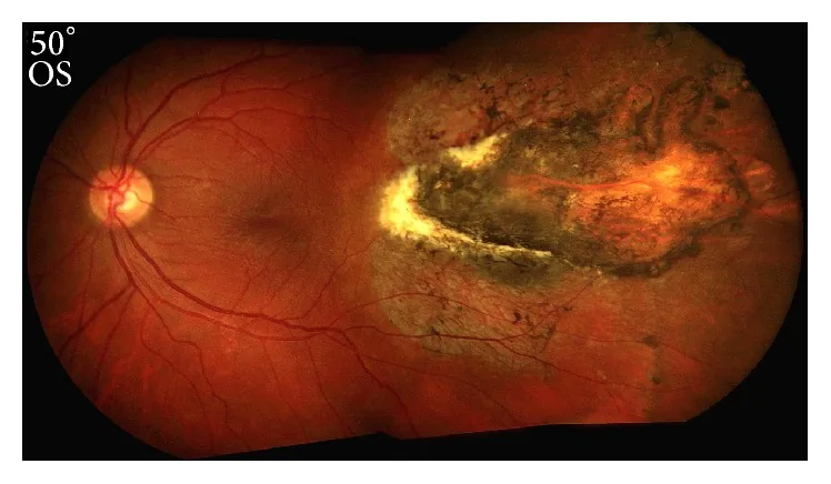 Chorioretinitis Sclopetaria image