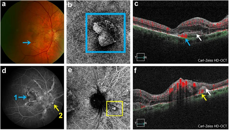Choroidal Neovascularization OCT Angiography Findings image