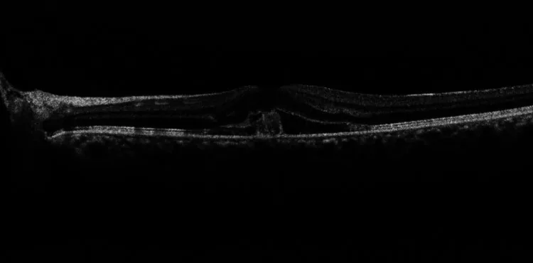 Choroidal Rupture image