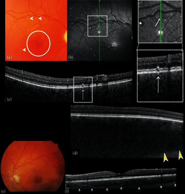 Cobalamin C Deficiency image