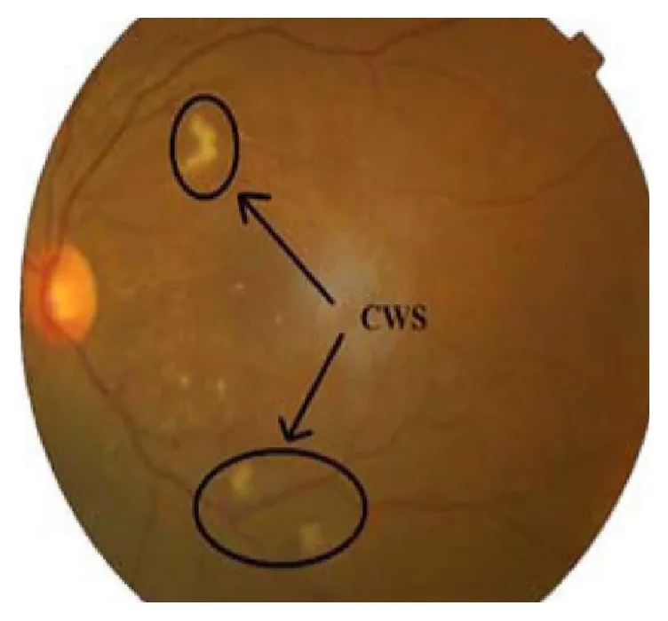 Cotton Wool Spots image