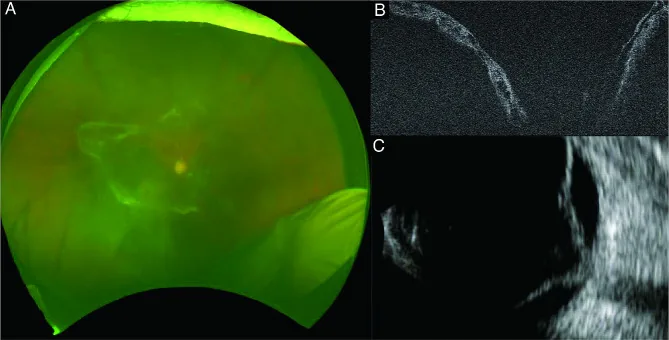 Crunch Syndrome image