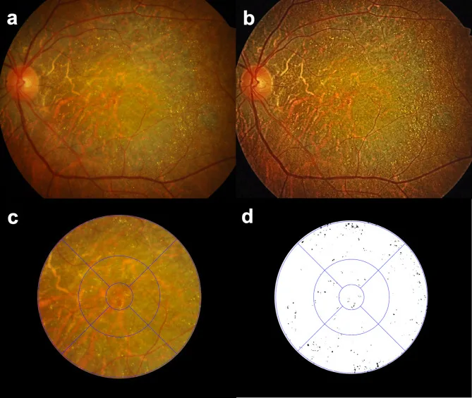 Crystalline Retinopathy image