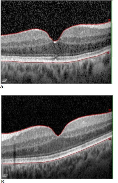 Cystoid Macular Edema image
