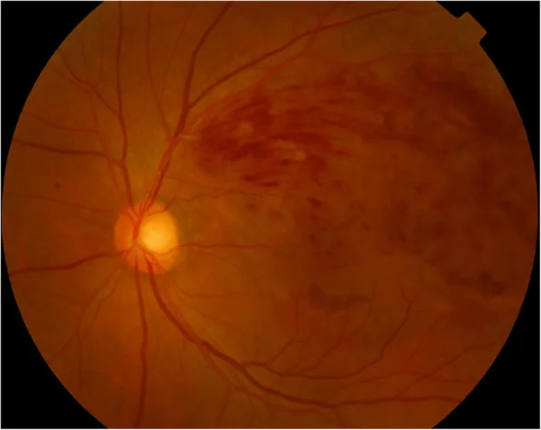 Dexamethasone Intravitreal Implant image