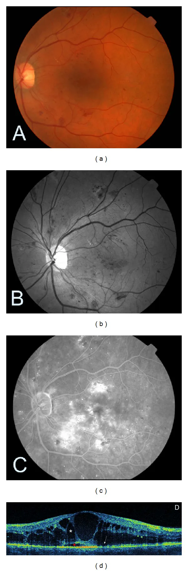 Diabetic Macular Edema image