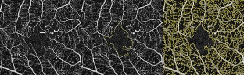 Diabetic Macular Ischemia image