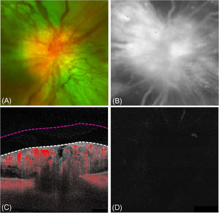 Diabetic Papillopathy image