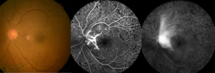 Diabetic Retinopathy Pathophysiology image