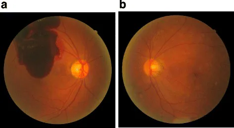 Diabetic Retinopathy Screening image