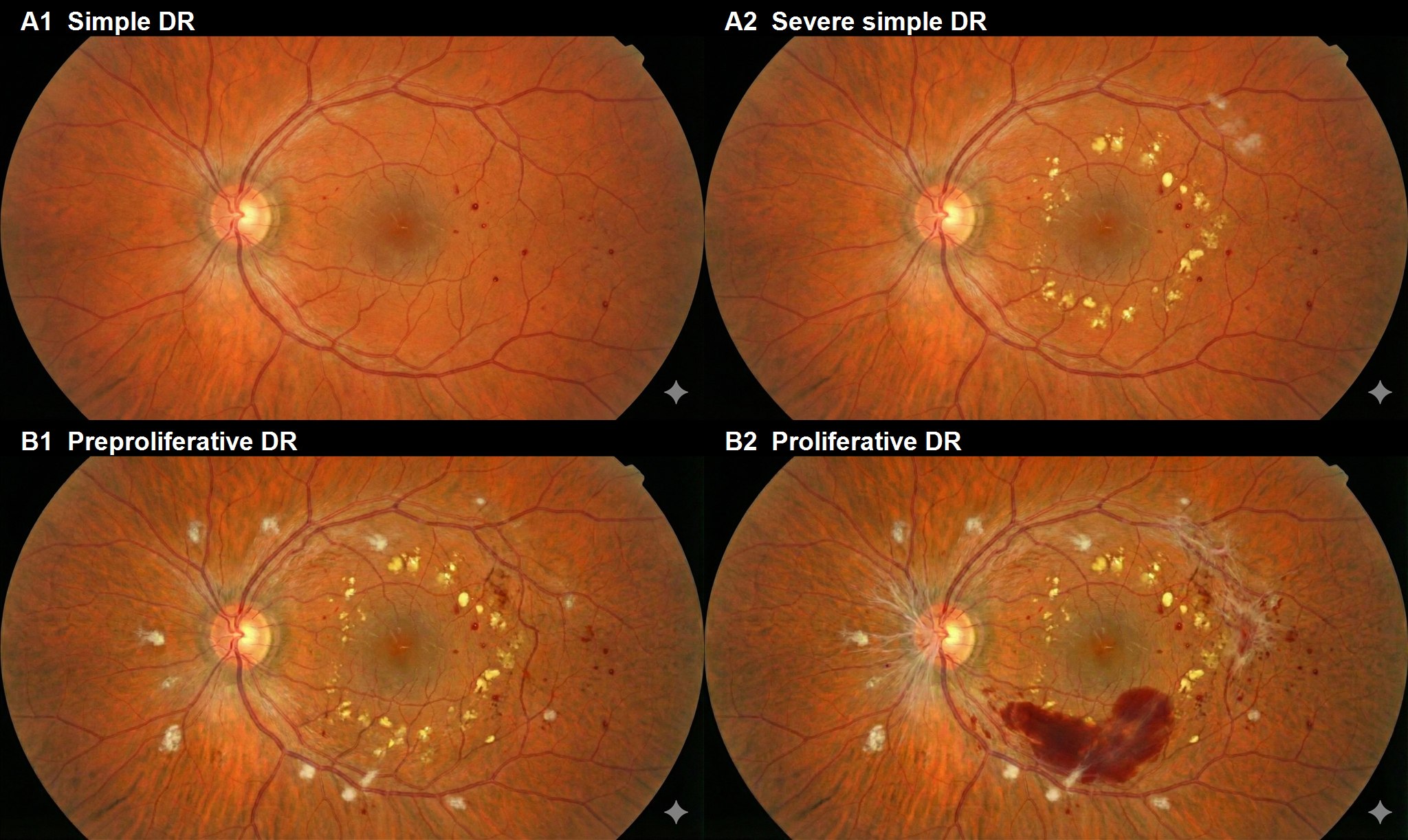 AI生成による糖尿病網膜症の病期イメージ。A1、A2、B1、B2の順に病変が進行する