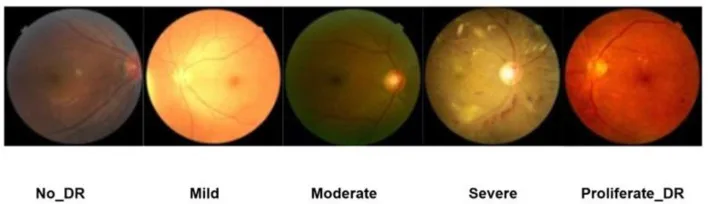 AI-generated image of diabetic retinopathy stages. Lesions progress in order of A1, A2, B1, B2.