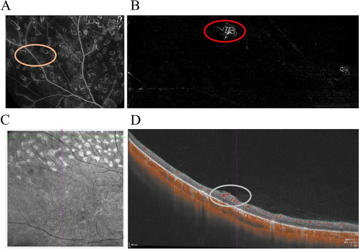 Diabetic Retinopathy image