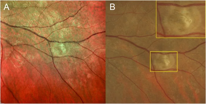 Diffuse Unilateral Subacute Neuroretinitis  DUSN image