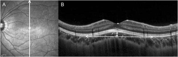 Dome-Shaped Macula image
