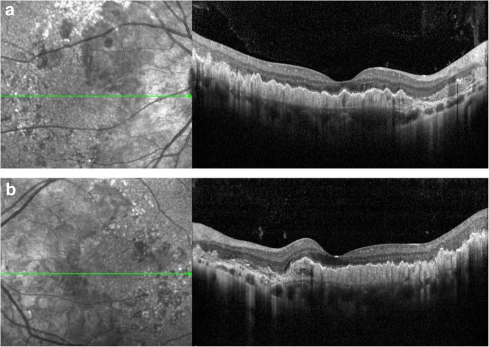 Doyne Honeycomb Retinal Dystrophy image