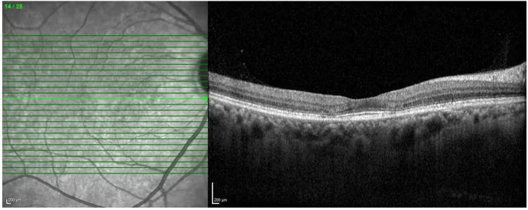 Drug Induced Maculopathy image