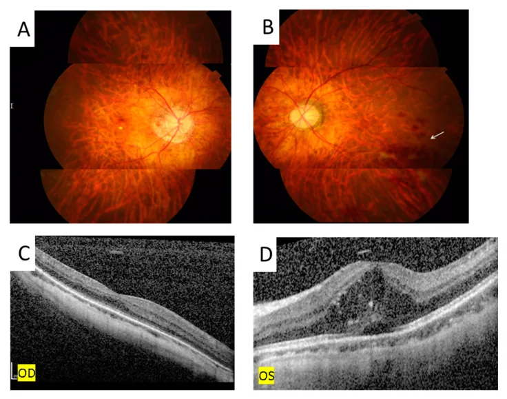 Eales Disease image