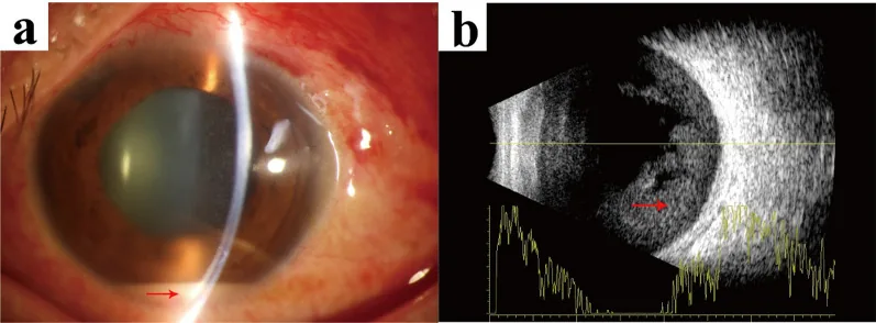 Endophthalmitis image