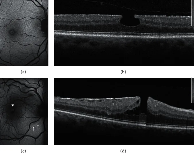 Epiretinal Membrane image