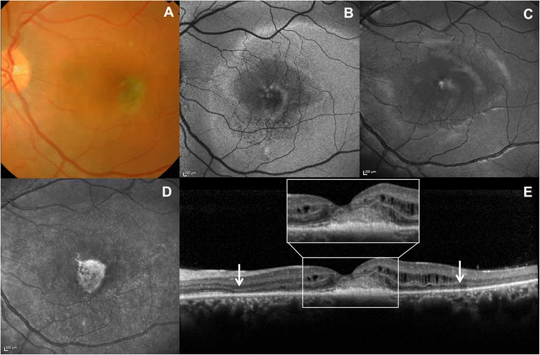 Exudative Retinal Detachment image