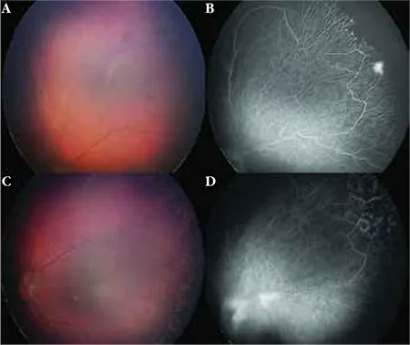 Familial Exudative Vitreoretinopathy  FEVR image