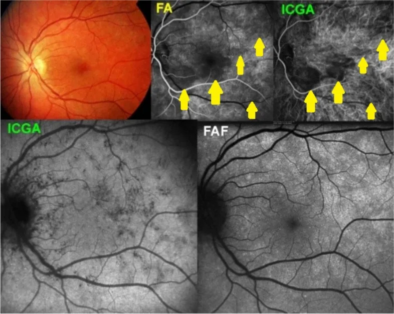 Fluorescein Angiography image