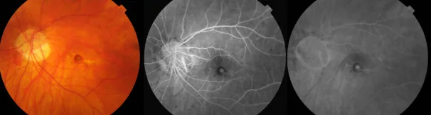 病的近視に伴う古典型脈絡膜新生血管のカラー眼底写真とフルオレセイン蛍光眼底造影の早期相・後期相。左眼中心窩に早期相で境界明瞭な円形の過蛍光と周囲の低蛍光ハローがあり、後期相で辺縁がにじんで軽度に拡大している。