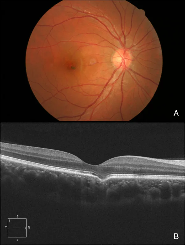 Focal Choroidal Excavation  FCE image
