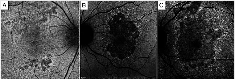 Fundus Autofluorescence image