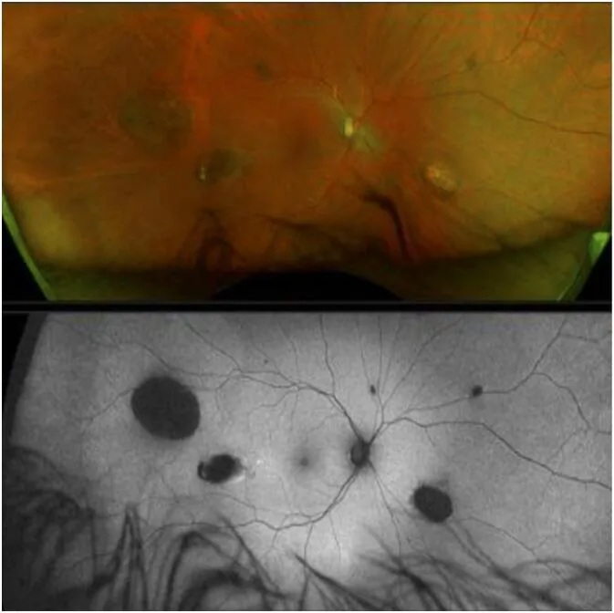 Gardner Syndrome image