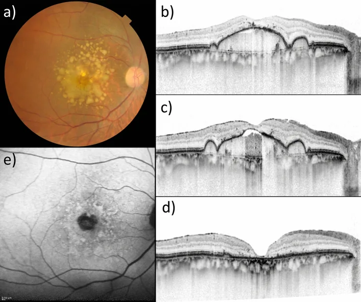 Geographic Atrophy image