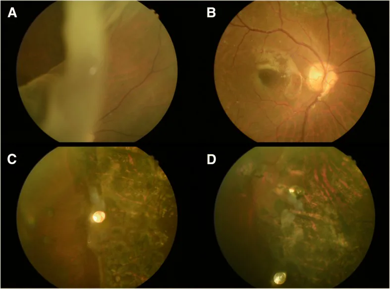 Giant Retinal Tears image